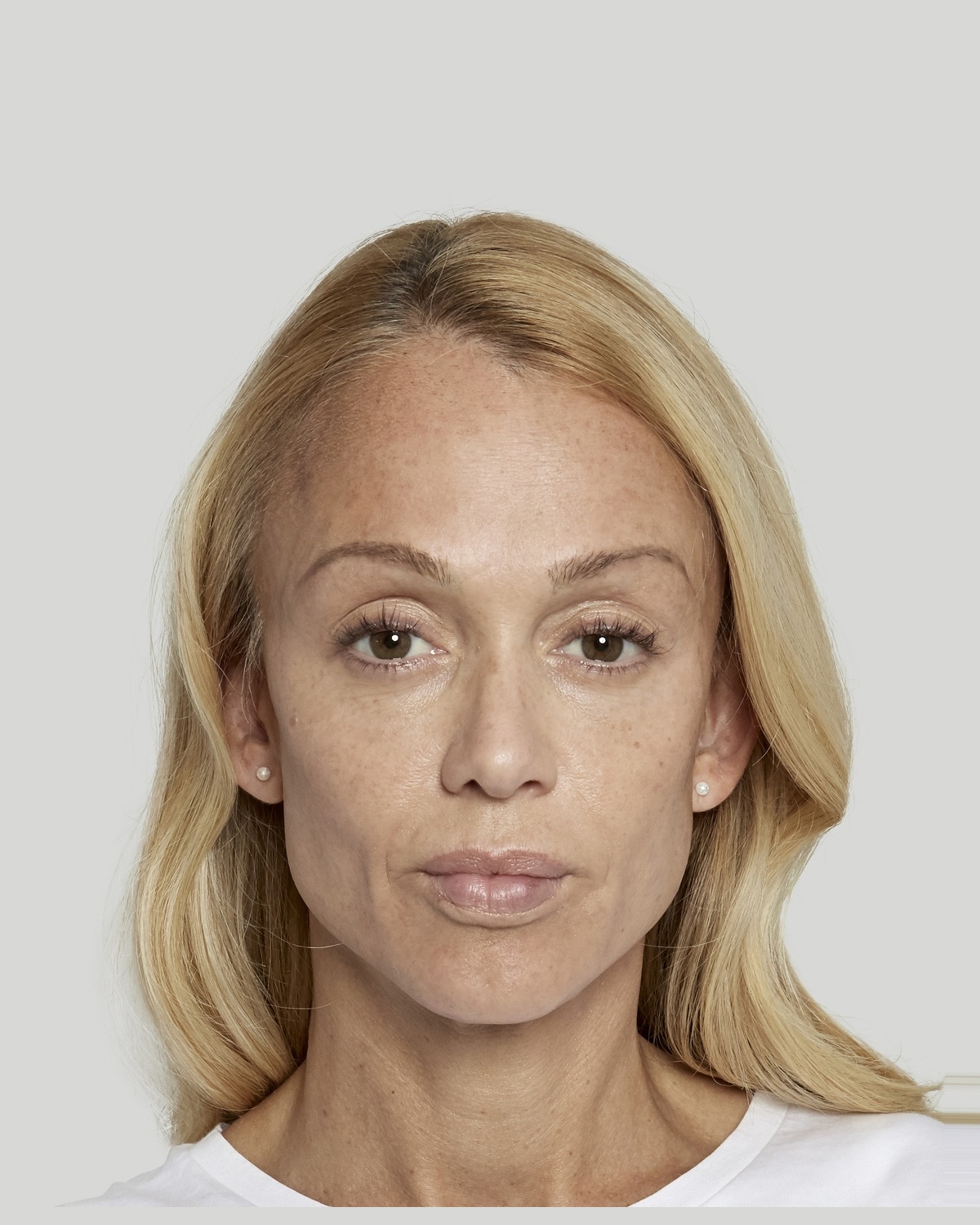 Anna after Sculptra treatment, 24 weeks