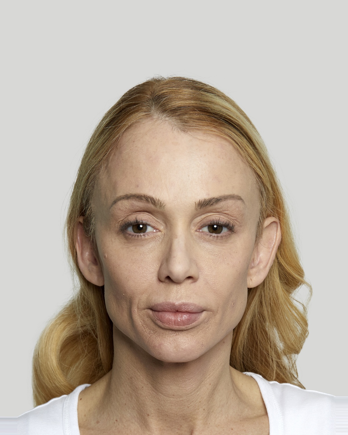 Anna before Sculptra treatment