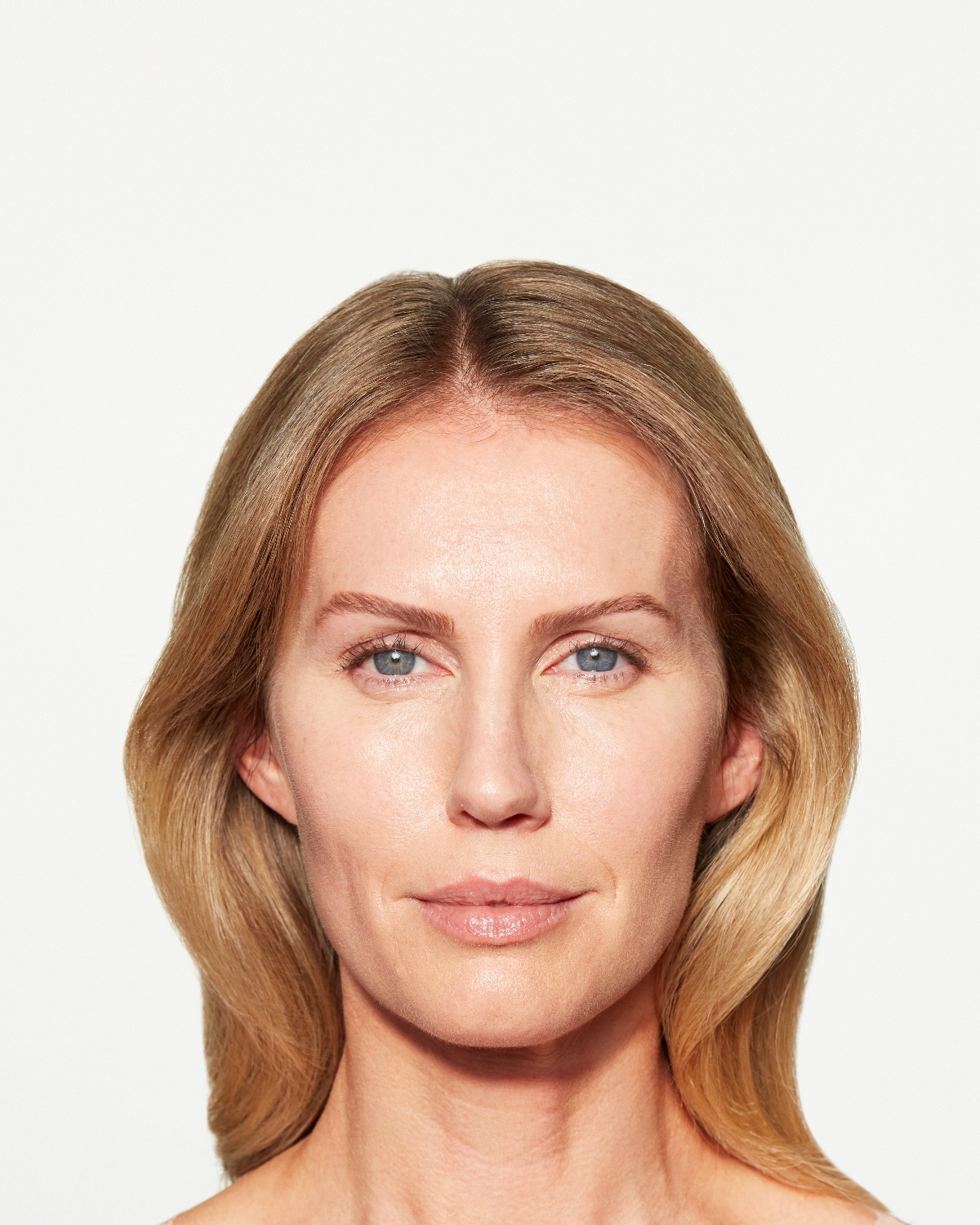 Chloe after Sculptra cheek treatment, 6 months