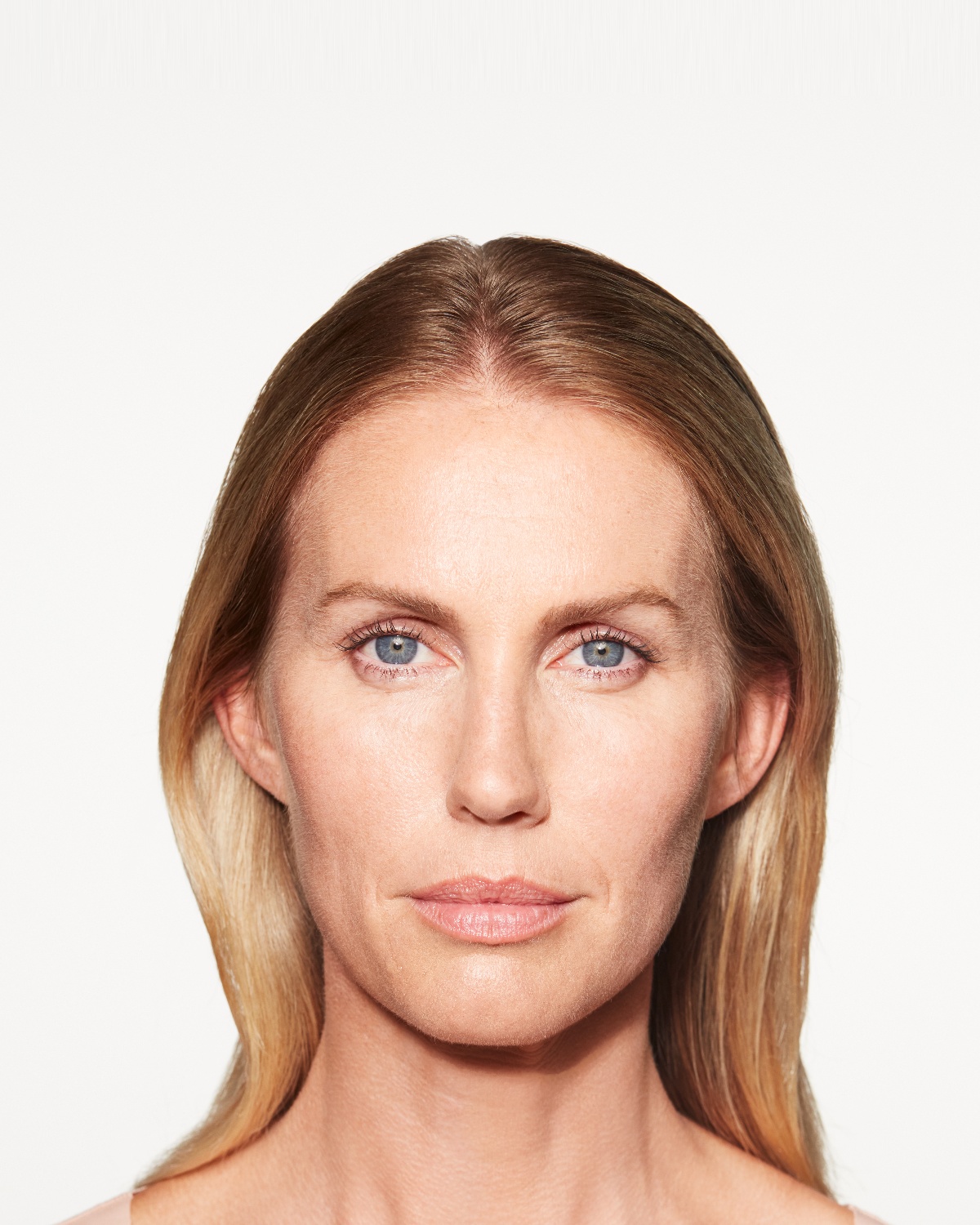 Chloe before Sculptra cheek treatment