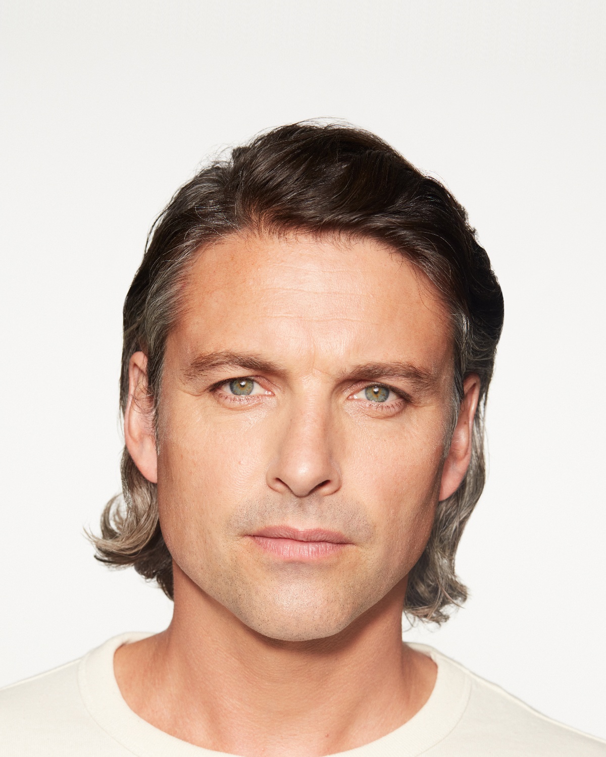 Christian after Sculptra cheek treatment, 6 months