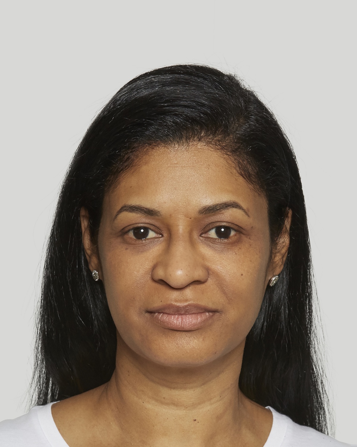 Evelyn after Sculptra treatment, 14 weeks
