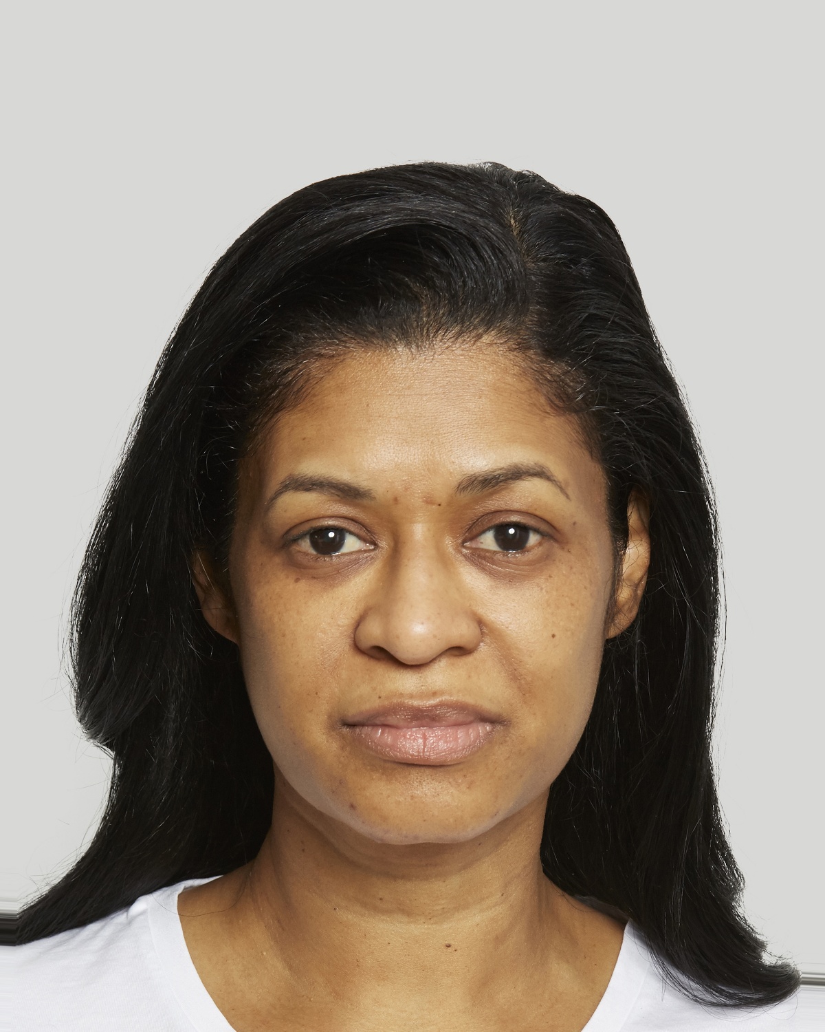Evelyn before Sculptra treatment
