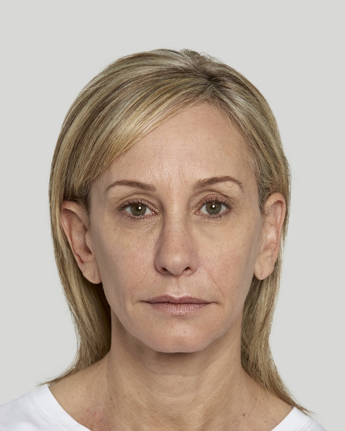 Hydi after Sculptra treatment, 27 weeks