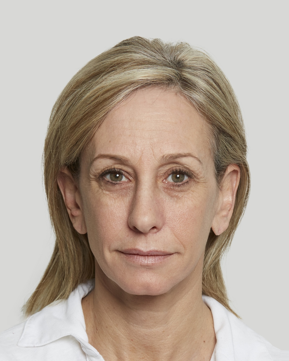 Hydi before Sculptra treatment