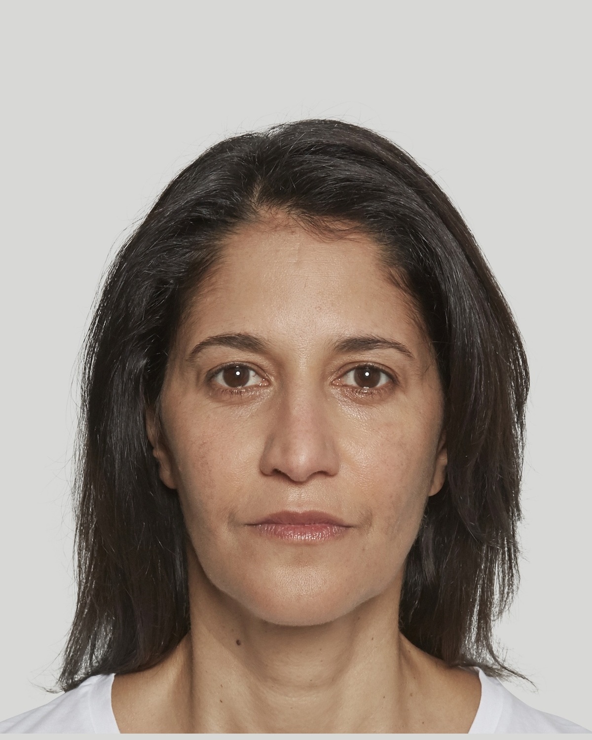 Sandra after Sculptra treatment