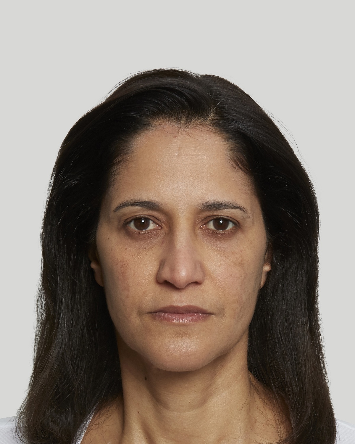 Sandra before Sculptra treatment